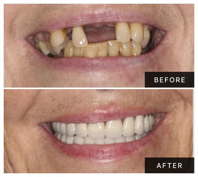 Khanani Dental patient before and after All-on-4 dental implants