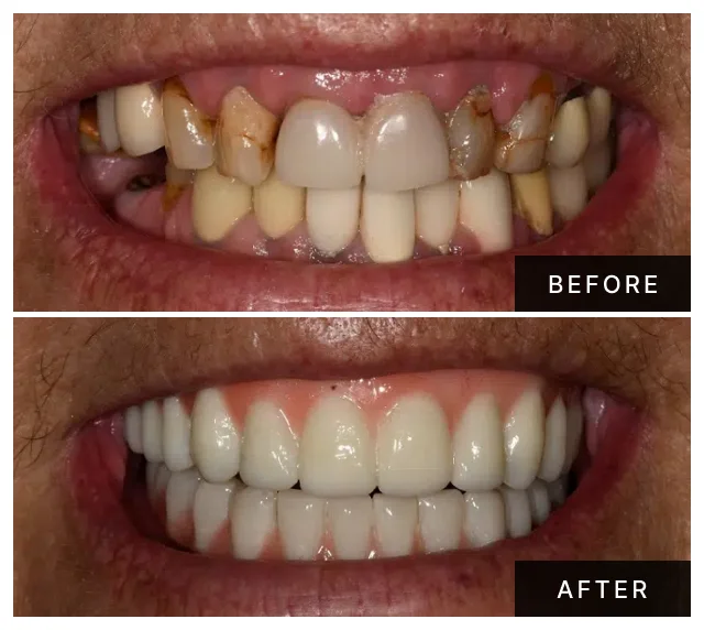 Khanani Dental patient before and after All-on-4 dental implants
