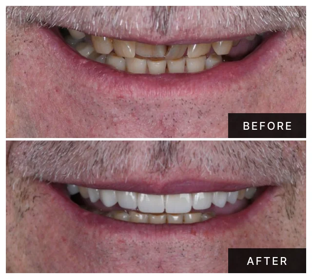 Khanani Dental patient before and after All-on-4 dental implants
