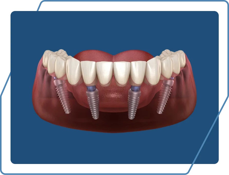 All-on-4 dental implant illustration