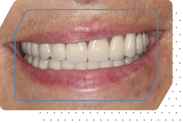 Permanent All-on-4<sup>®</sup> dental implants